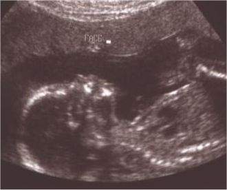Her last Ultrasound on Jan.7, 2005